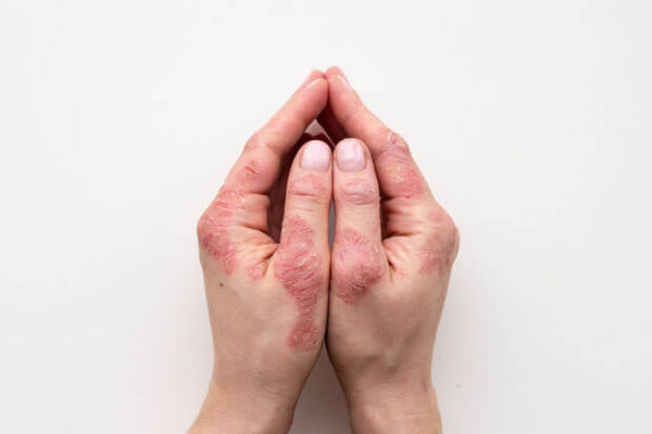 Qual a relação entre alimentação e psoríase?